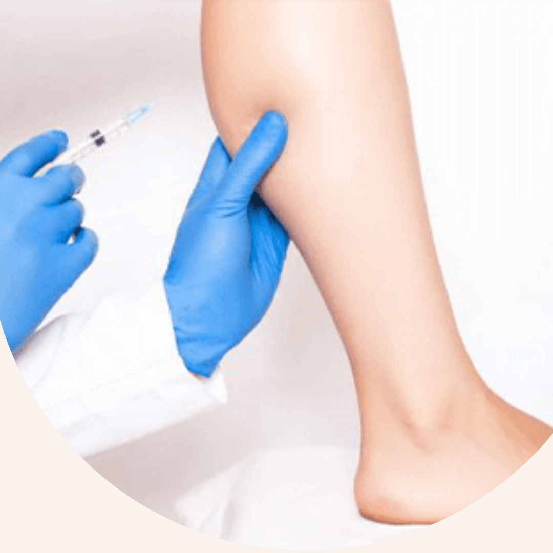 Sclerotherapy
